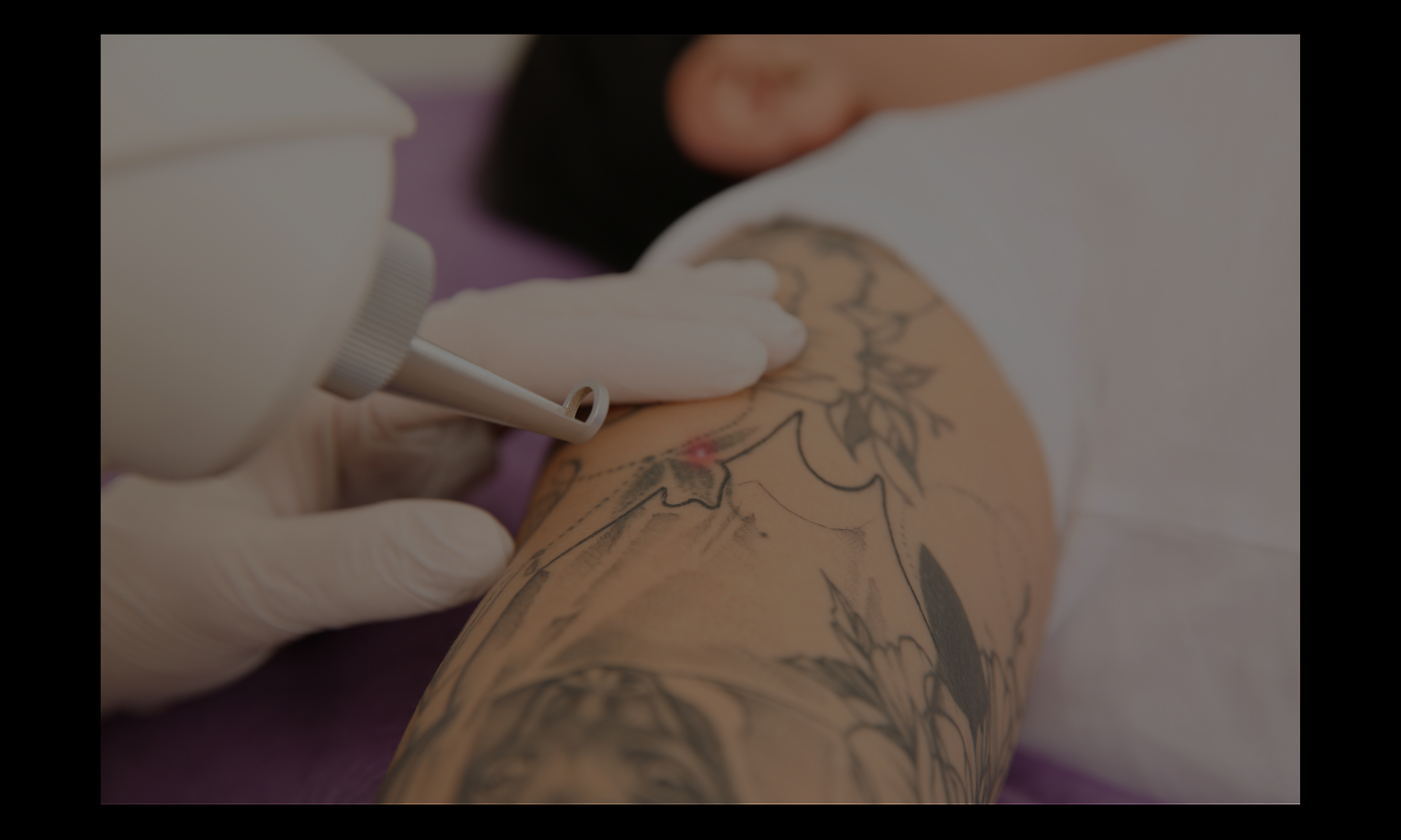 TATTOO REMOVAL